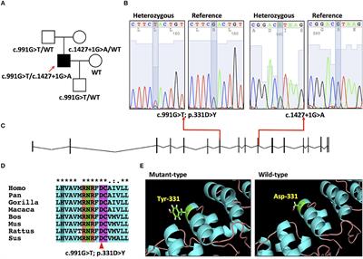 Early-Onset Parkinson's Disease Caused by PLA2G6 Compound Heterozygous Mutation, a Case Report and Literature Review